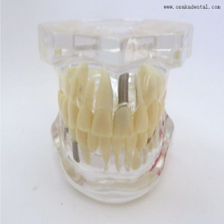 Modèle d'implant dentaire de dents pathologiques pour la pratique
