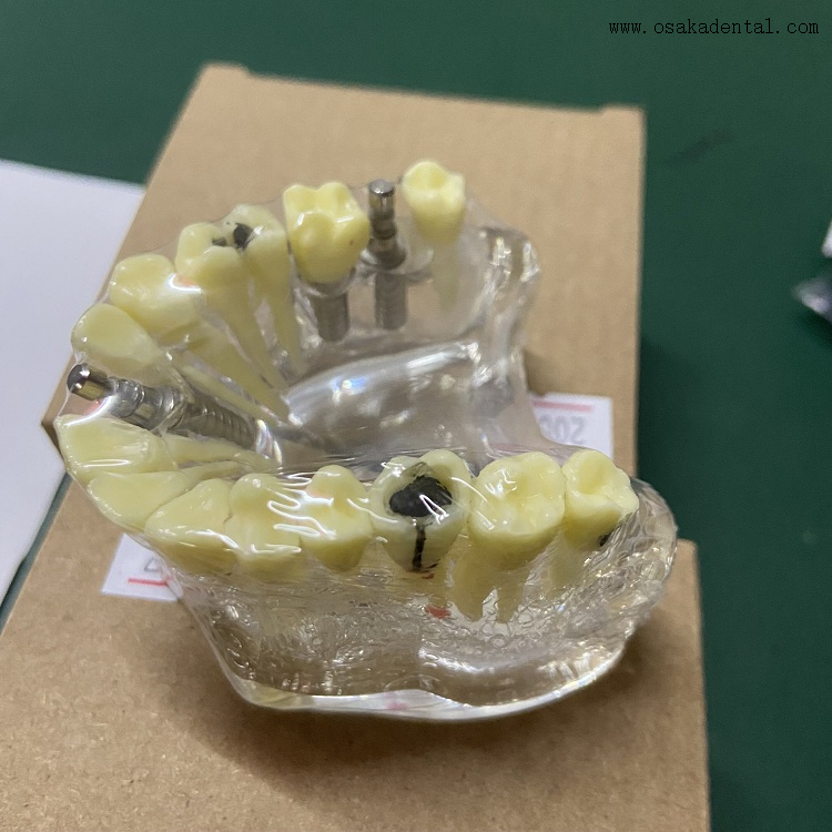 Modèles d'implants dentaires avec carie OSA-2008A